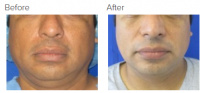 Chin Liposuction with Dr. Kenneth Hughes 123