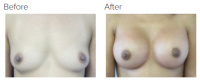 Breast Augmentation (Implants) with Dr. Kenneth Benjamin Hughes 125