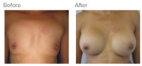 Breast Augmentation (Implants) with Dr. Kenneth Benjamin Hughes 154