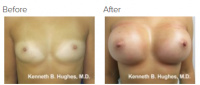 Breast Augmentation (Implants) with Dr. Kenneth Benjamin Hughes 156