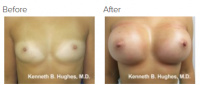 Breast Augmentation (Implants) with Dr. Kenneth Benjamin Hughes 127