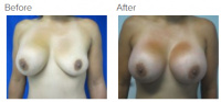 Breast Augmentation (Implants) with Dr. Kenneth Benjamin Hughes 158