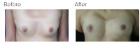 Breast Augmentation with Fat Grafting with Dr. Kenneth Benjamin Hughes 1