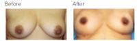 Breast Augmentation with Fat Grafting with Dr. Kenneth Benjamin Hughes 3