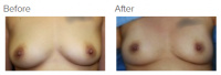 Breast Augmentation with Fat Grafting with Dr. Kenneth Benjamin Hughes 5