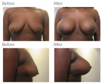 Breast Augmentation and Lift with Dr. Kenneth Benjamin Hughes 7
