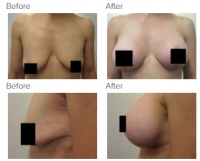 Breast Augmentation and Lift with Dr. Kenneth Benjamin Hughes 9