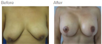 Breast Augmentation and Lift with Dr. Kenneth Benjamin Hughes 134