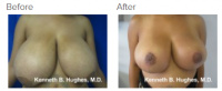 Breast Reduction and Breast Lift with Dr. Kenneth Benjamin Hughes 15