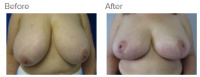 Breast Reduction and Breast Lift with Dr. Kenneth Benjamin Hughes 16
