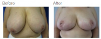 Breast Reduction and Breast Lift with Dr. Kenneth Benjamin Hughes 138