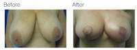 Breast Reduction and Breast Lift with Dr. Kenneth Benjamin Hughes 17
