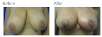 Breast Reduction and Breast Lift with Dr. Kenneth Benjamin Hughes 139