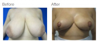 Breast Reduction and Breast Lift with Dr. Kenneth Benjamin Hughes 18