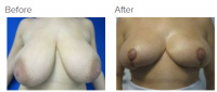 Breast Reduction and Breast Lift with Dr. Kenneth Benjamin Hughes 140