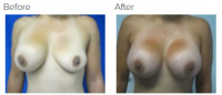 Breast Augmentation Revision with Dr. Kenneth Benjamin Hughes 19