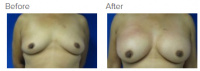 Breast Reconstruction and Breast Deformity Correction with Dr. Kenneth Benjamin Hughes 22