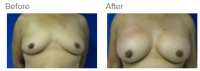 Breast Reconstruction and Breast Deformity Correction with Dr. Kenneth Benjamin Hughes 144