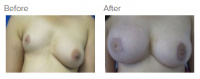 Breast Reconstruction and Breast Deformity Correction with Dr. Kenneth Benjamin Hughes 145