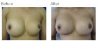 Breast Reconstruction and Breast Deformity Correction with Dr. Kenneth Benjamin Hughes 24