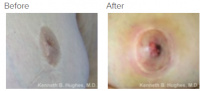 Inverted Nipple Correction by Dr. Kenneth Benjamin Hughes 147