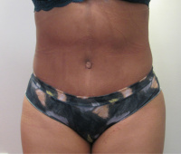 Tummy Tuck Los Angeles with Dr. Kenneth Benjamin Hughes 27