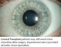 Corneal transplant care 5