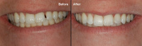 Single Appointment  Bonding Procedure 5