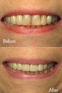 Smile Makeovers 3