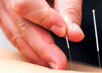 Dry Needling 2