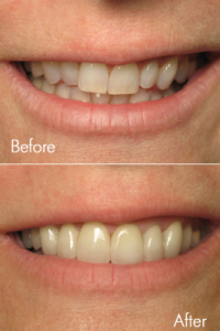 Smile Makeovers 0