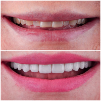 porcelain veneers 2