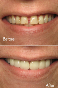 Smile Makeovers 2