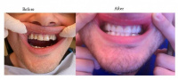 Porcelain Veneers - Before & After 10