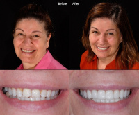 Porcelain Veneers 10