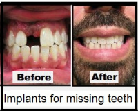 immediate implant  2