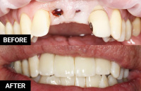 Before & After: Dental Implant Crown Restoration 2