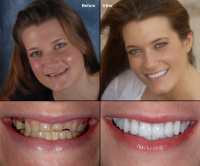 Full mouth Rehabilitation 12