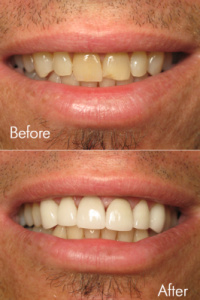 Smile Makeovers 12