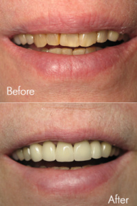 Smile Makeovers 10