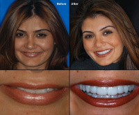 Full Mouth Rehabilitaiton 14