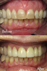 Smile Makeovers 5