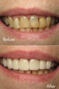 Smile Makeovers 6