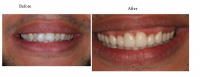 Porcelain Veneers - Before & After 9