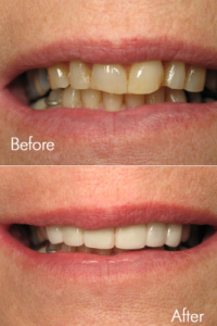 Smile Makeovers 7