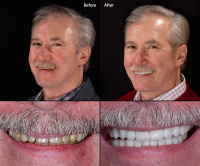 Porcelain Veneers 15