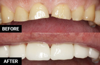 Before & After: Dental Crowns 1