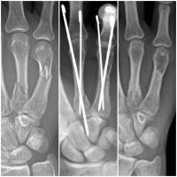 Metacarpal fractures at time of injury, pinning, and 6 weeks post-op. 3