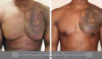 before and after liposuction 1