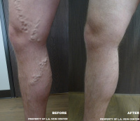 Vein Treatment by Dr. Lee @ L.A. Vein Center in Sherman Oaks 1